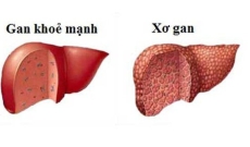 Kiểm tra chức năng gan như thế nào?