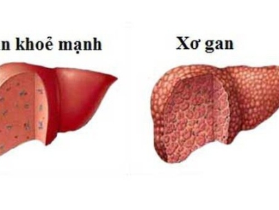 Kiểm tra chức năng gan như thế nào?