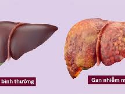 GAN NHIỄM MỠ