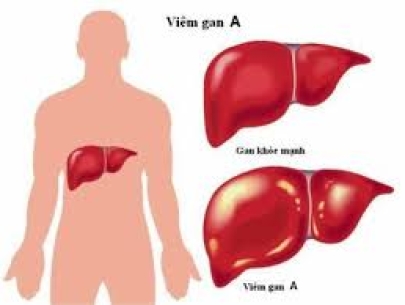 VIÊM GAN A