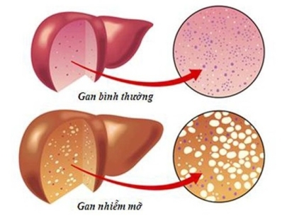 10 nguy cơ và dấu hiệu bệnh gan.